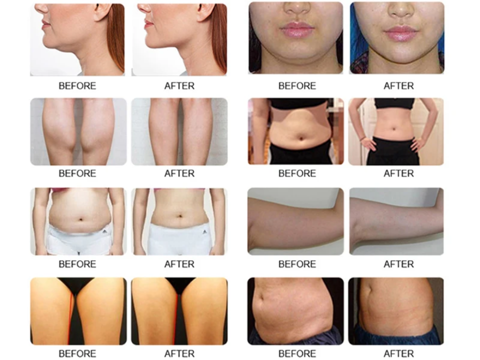 Body contouring reference collage