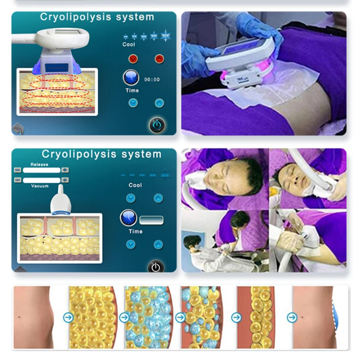 Cryolipolysis treatment process visual